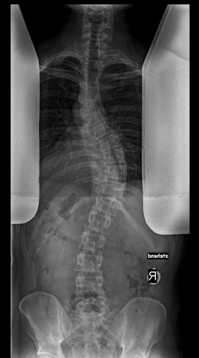 Skoliose Wirbelsäulenverkrümmung Schroth Spiraldynamik